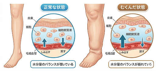 むくみの原因を解説している画像